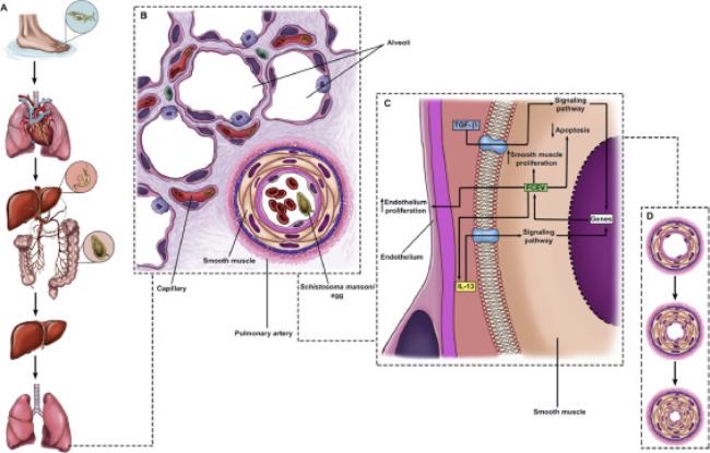 Medical illustration of the lungs and pulmonary artery affected by schistosomiasis